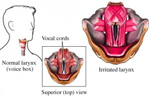 viral laryngitis