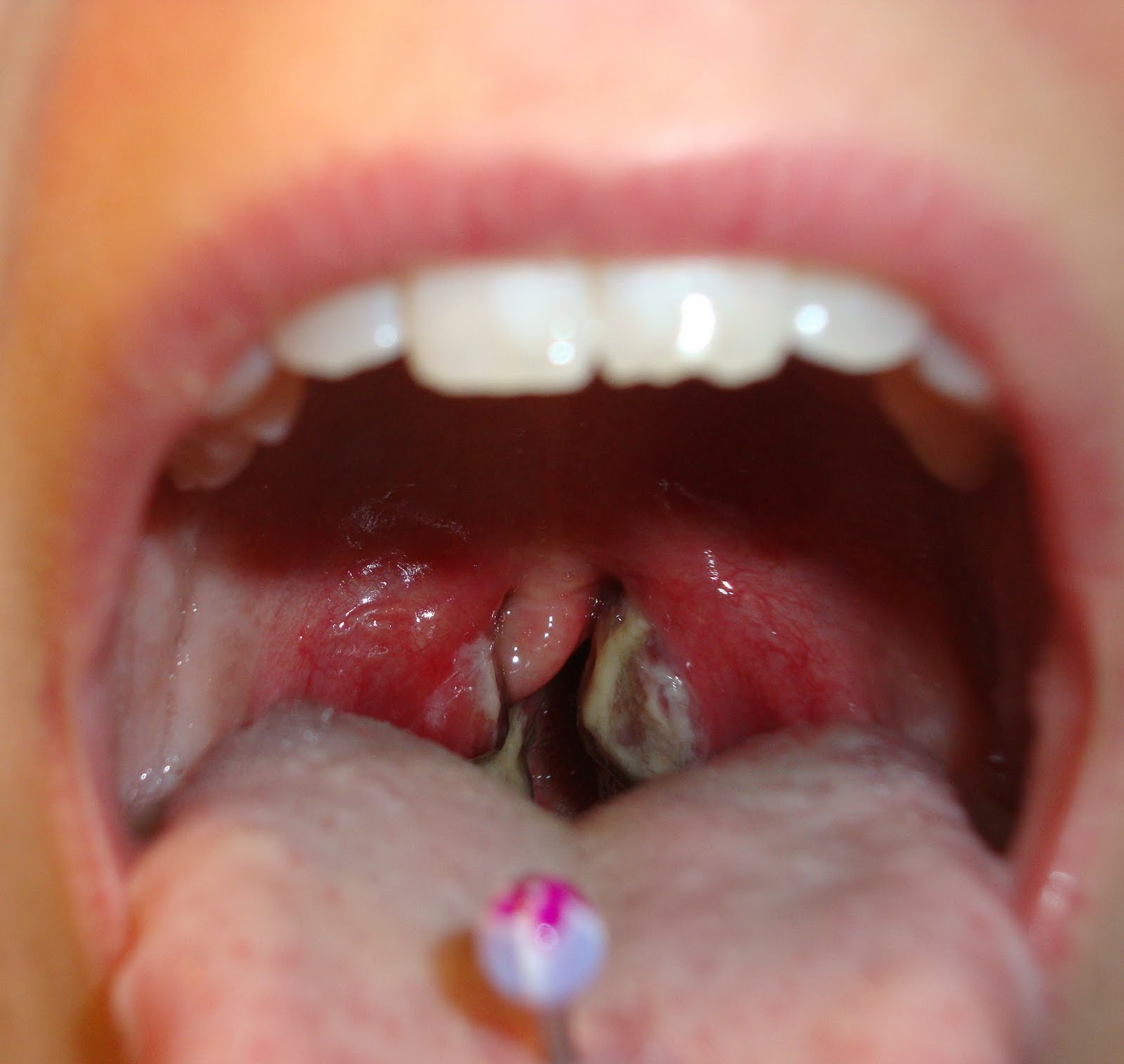 Images Of Strep Throat 97