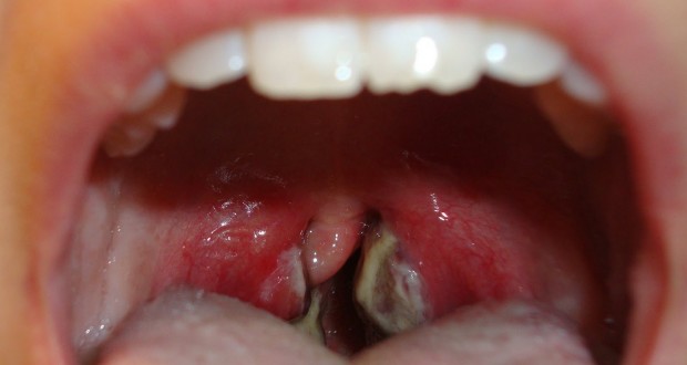 symptoms throat Adult strep